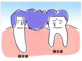 歯が中間で1本抜けた場合(ブリッジ)