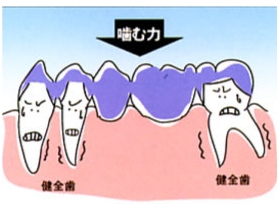歯が中間で2本抜けた場合(ブリッジ)