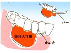 奥歯が数本抜けた場合(部分入れ歯)