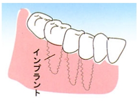 奥歯が数本抜けた場合
