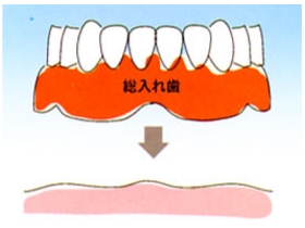 歯が全部抜けた場合(総入れ歯)