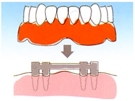 歯が全部抜けた場合