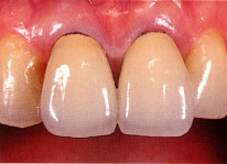 審美歯科治療前