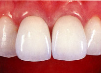 審美歯科治療後