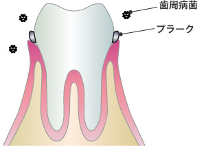 初期の歯周病