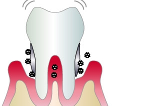重度の歯周病